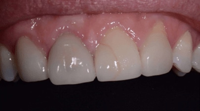 Dental Veneers before image