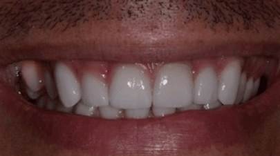 Whitening veneers after picture