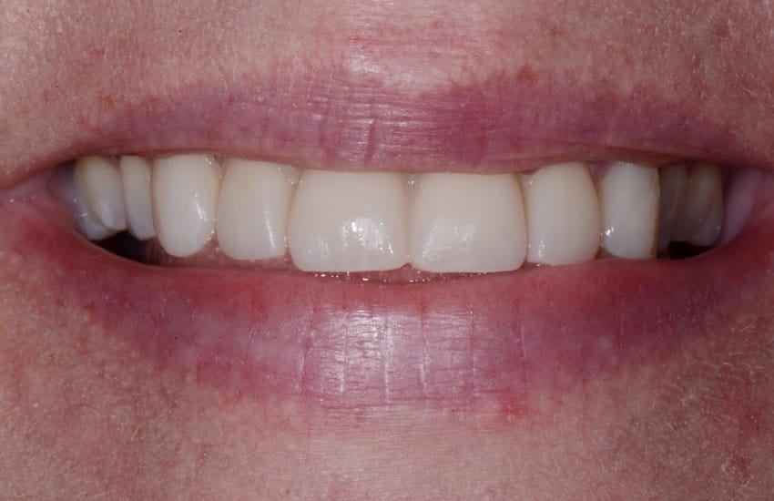 up close image of patient's smile before treatment