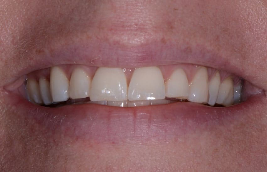 up close image of patient's smile after treatment