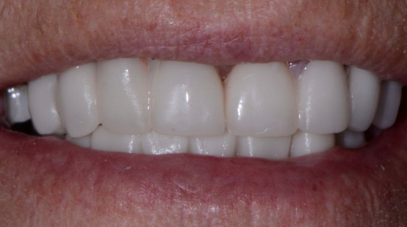 May 2026 Smile Gallery patient close up after