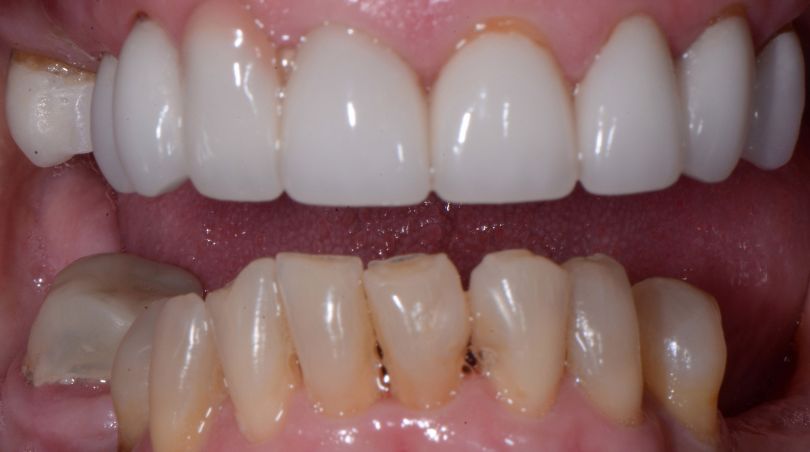 May 2026 Smile Gallery patient close up before